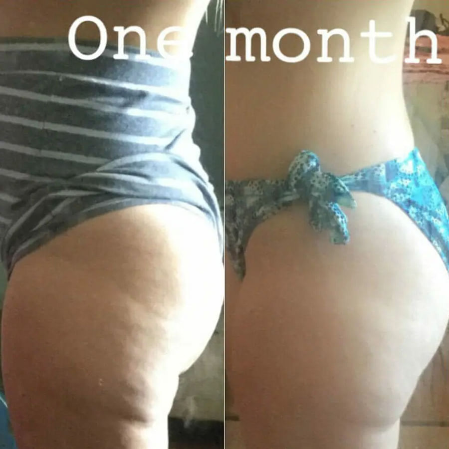 Before and after transformation of individuals reducing cellulite through weightlifting