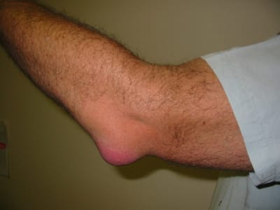 From Pain to Gain: Managing Elbow Pain in Weightlifting