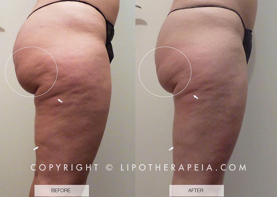 Before and after images of individuals who adopted weightlifting for cellulite reduction
